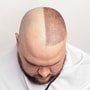 Stem Cell Treatment for Hair Transplant Package in Kuala Lumpur, Malaysia by FirstCell thumbnail