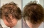 Hair loss treatment program thumbnail