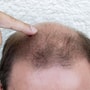 Platelet Rich Plasma for Hair Transplant in Mexico City, Mexico thumbnail