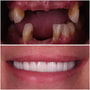 ITI Straumann All on 4 Dental Implants Package at Clinic Prime Istanbul, Istanbul, Turkey thumbnail