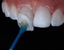 E-Max Laminate Veneers Package at Clinic Prime Istanbul, Turkey thumbnail