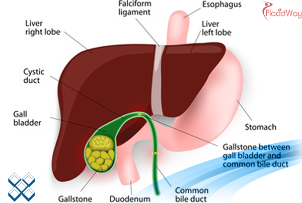 Laparoscopic Gallbladder Removal in Milan Italy