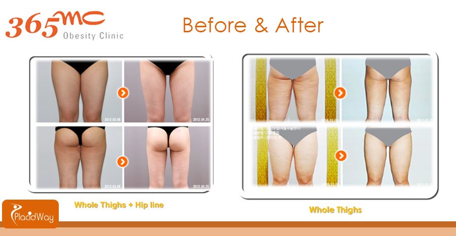 Top orthopedics not only for Daegu thigh liposuction but also for hip and knee area