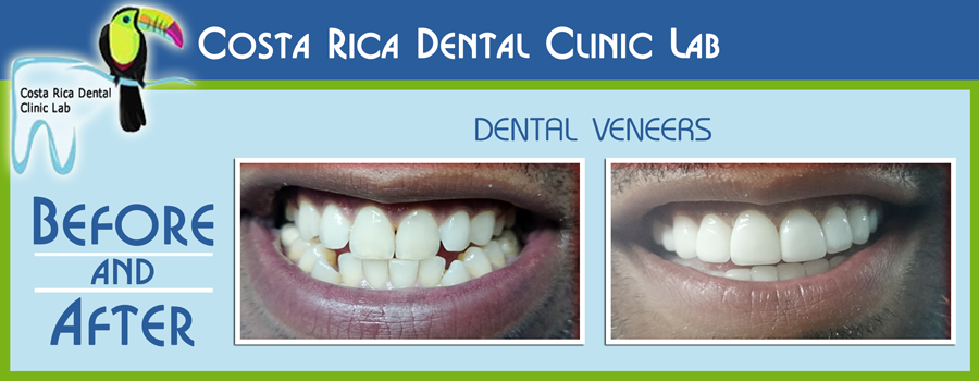 Dental Veneers Before and After - Costa Rica Dental Clinic Lab