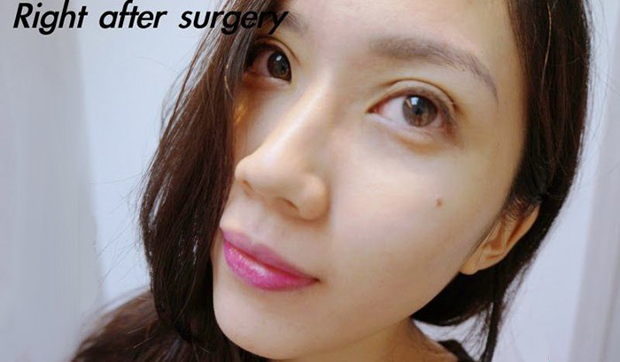 my double eyelid surgery experience