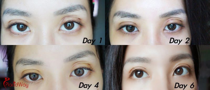 full incisional double eyelid surgery