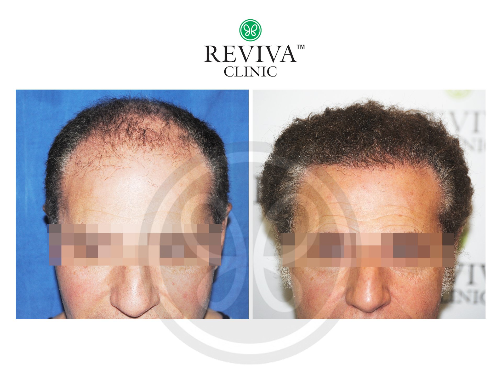Hair Transplant in Chandigarh India  Reviva Clinic