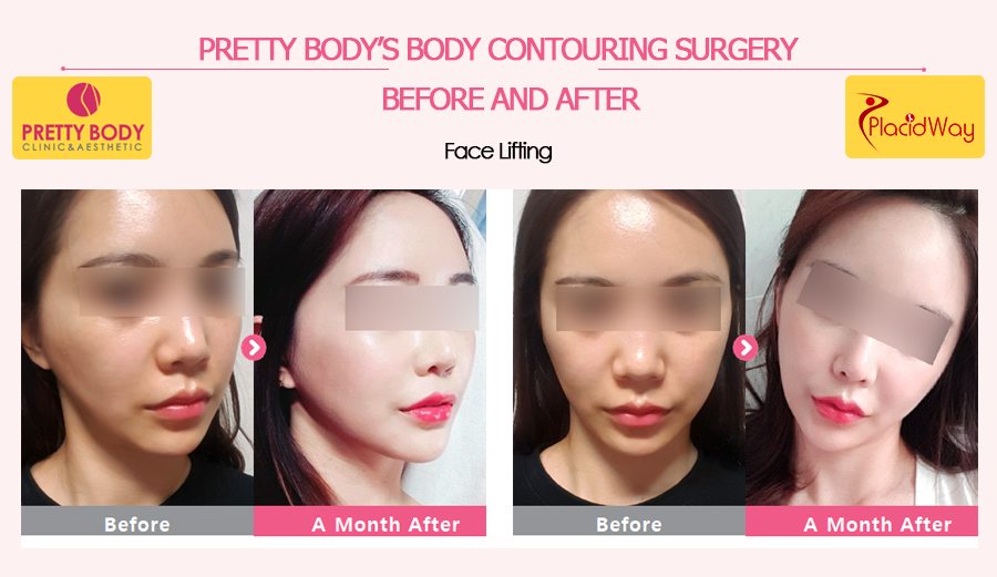 Before and After Face Lifting in Pretty Body Clinic, Seoul, South Korea