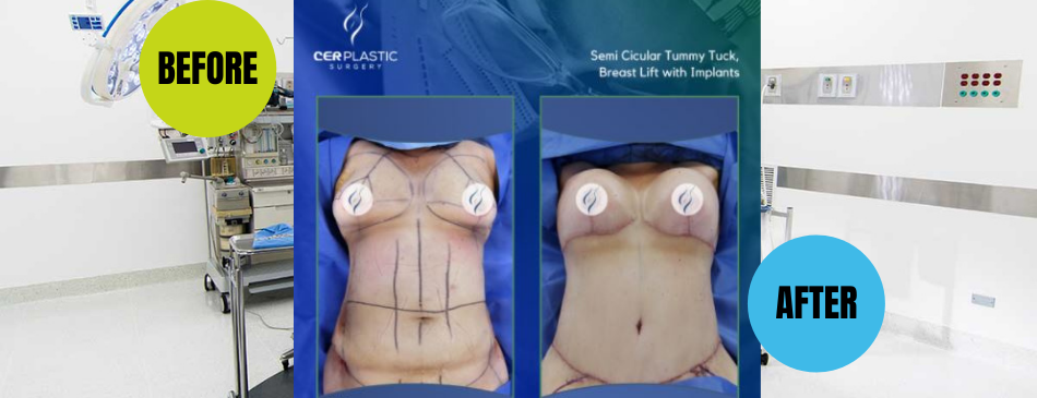 Breast Augmentation in Tijuana Mexico -$5000 in CER Hospital