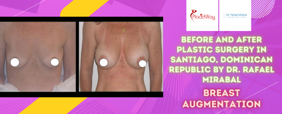 Before and After Breast Augmentation Surgery in Santiago, Dominican Republic by Dr. Rafael Mirabal