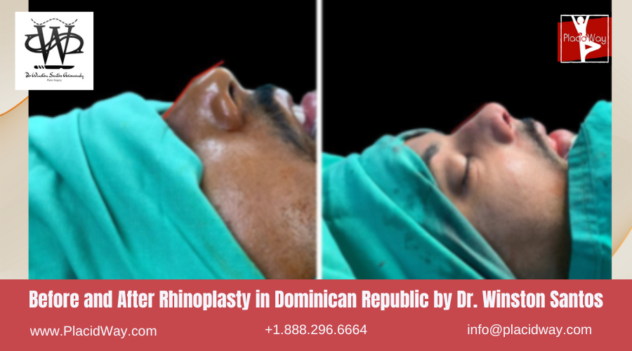 Rhinoplasty in Dominican Republic by Dr Winston Santos