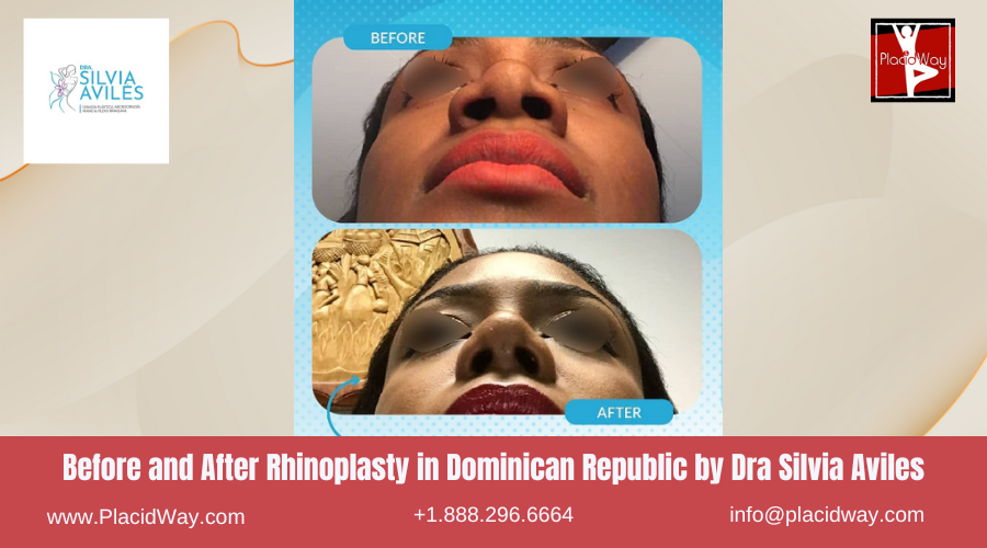 Rhinoplasty in Dominican Republic by Dra Silvia Aviles