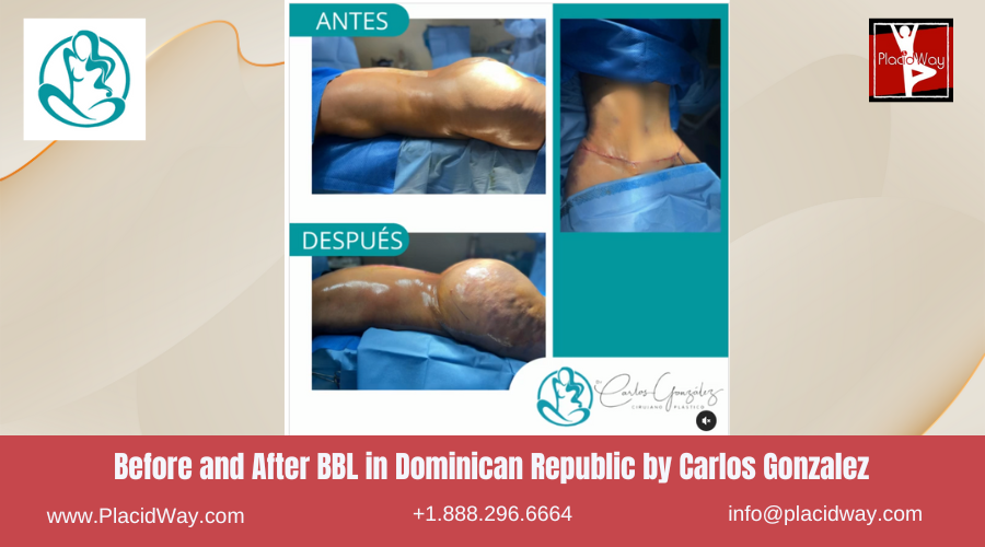 BBL in Dominican Republic by Carlos Gonzalez