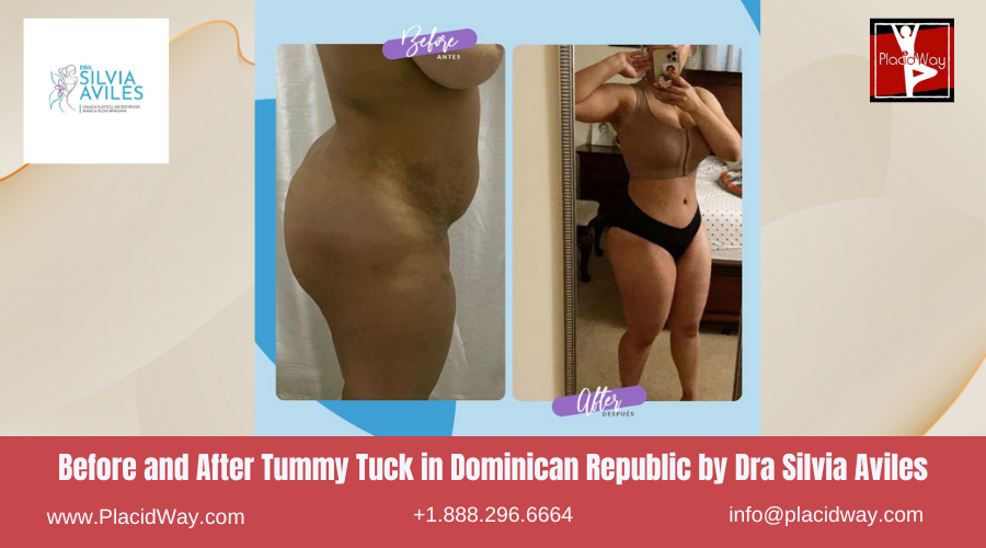 Abdominoplasty in Dominican Republic by Dra Silvia Aviles