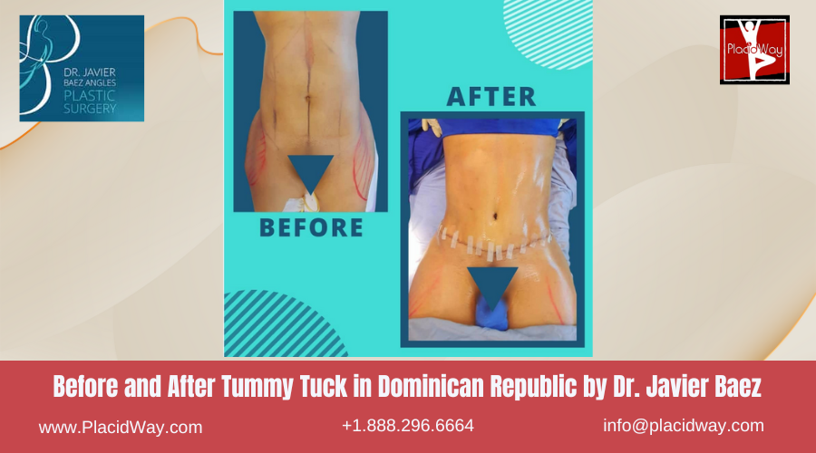 Tummy Tuck in Dominican Republic by Javier Baez