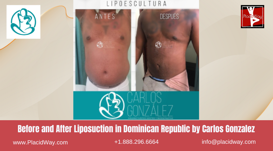 Lipo360 in Dominican Republic by Carlos Gonzalez