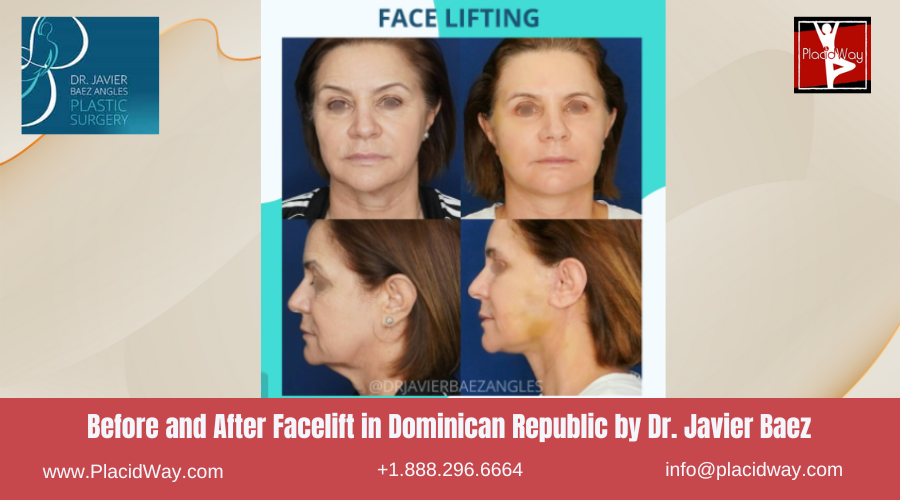 Facelift in Dominican Republic by Javier Baez