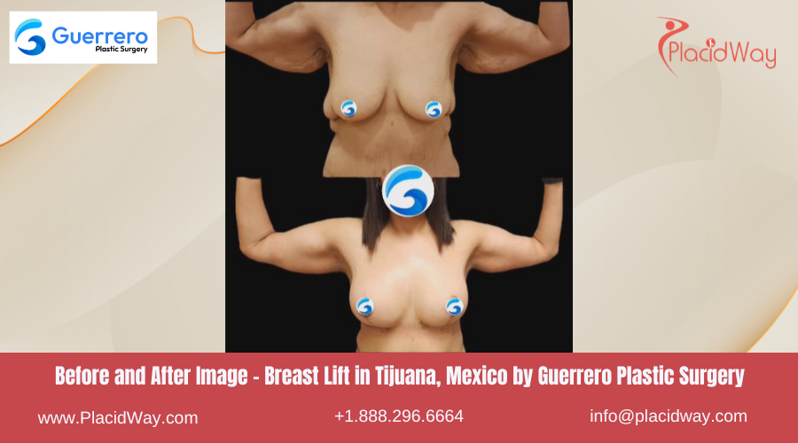 Breast Lift in Tijuana Mexico - Guerrero