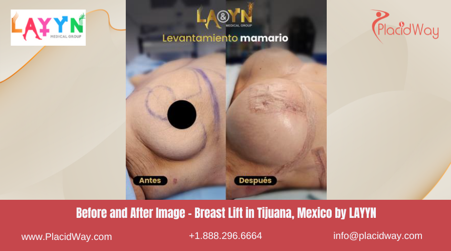 Breast Lift in Tijuana Mexico by LAYYN Medical Group