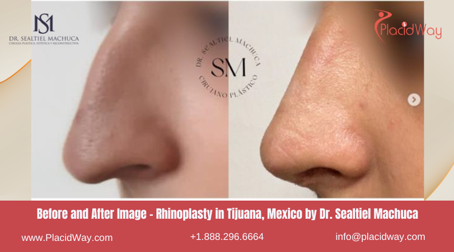 Rhinoplasty in Tijuana Mexico - Dr Sealtiel Machuca