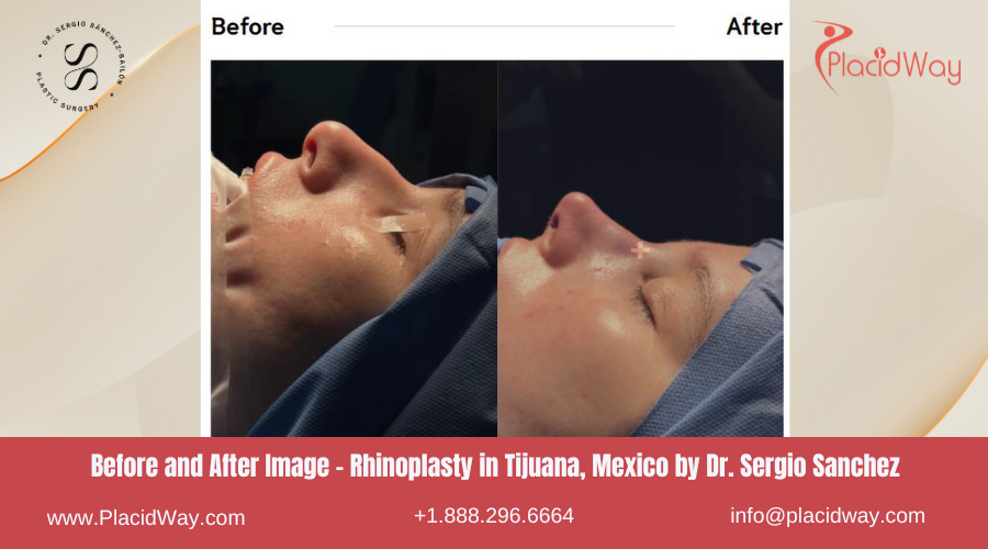 Rhinoplasty in Tijuana Mexico by Dr Sergio Sanchez