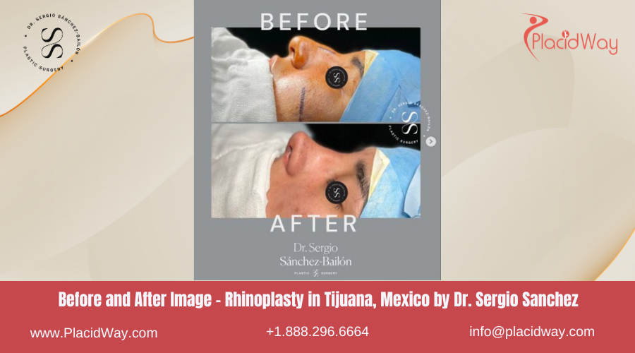 Rhinoplasty in Tijuana Mexico - Dr Sergio Sanchez Bailon