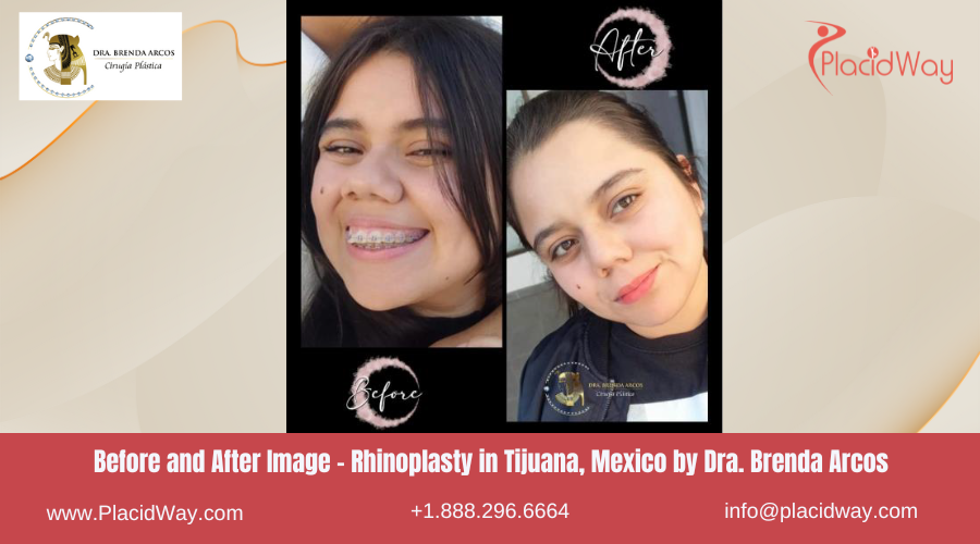 Rhinoplasty in Tijuana Mexico - Dra Brenda Arcos