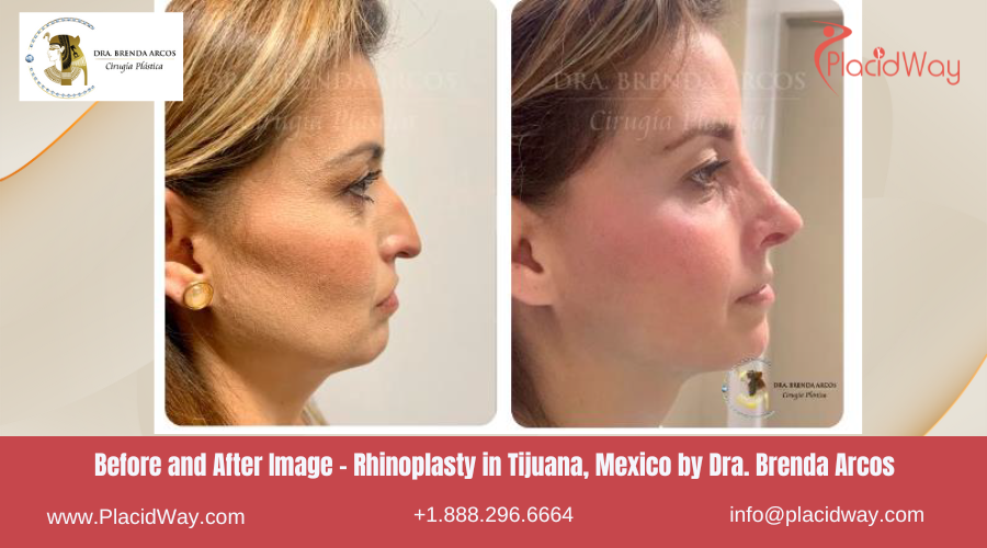 Rhinoplasty in Tijuana Mexico at Dra Brenda Arcos