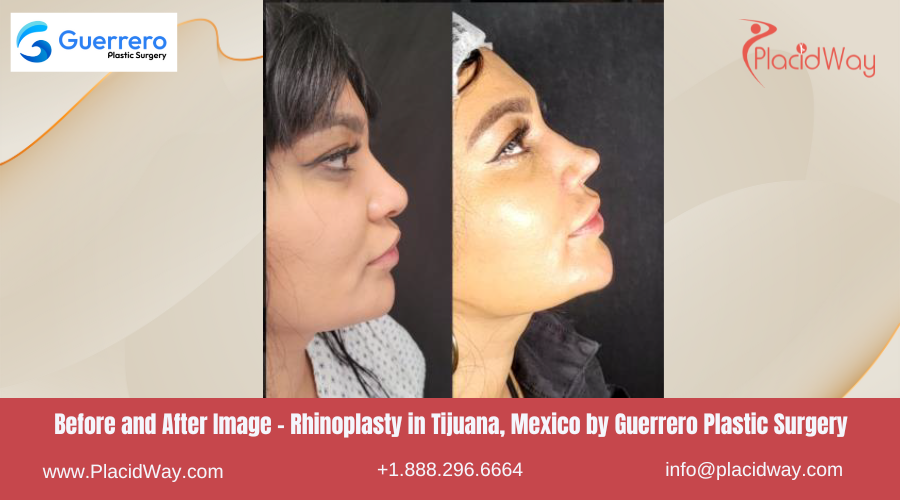 Rhinoplasty in Tijuana Mexico - Guerrero Plastic Surgery