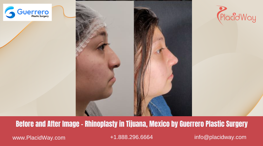 Rhinoplasty in Tijuana Mexico at Guerrero