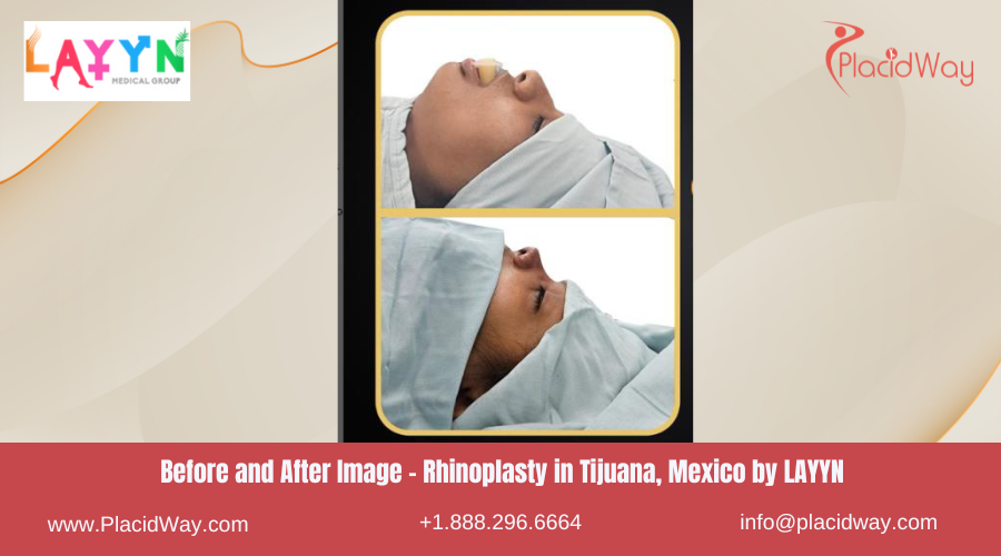 Rhinoplasty in Tijuana Mexico by LAYYN Medical Group