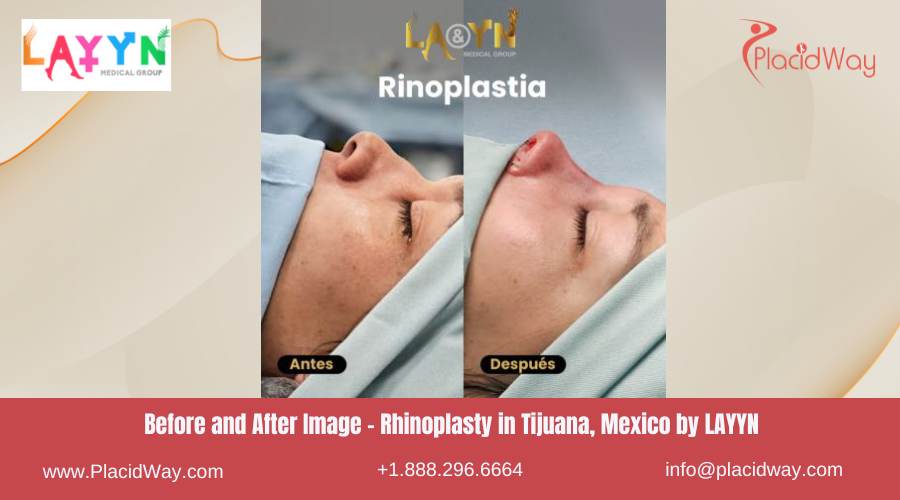 Rhinoplasty in Tijuana Mexico - LAYYN Hospital