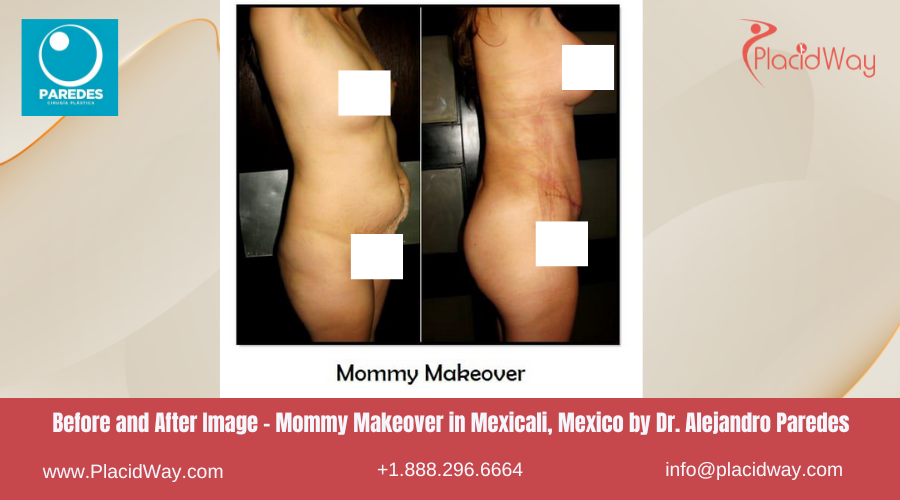 Mommy Makeover in Mexicali Mexico - Dr Paredes