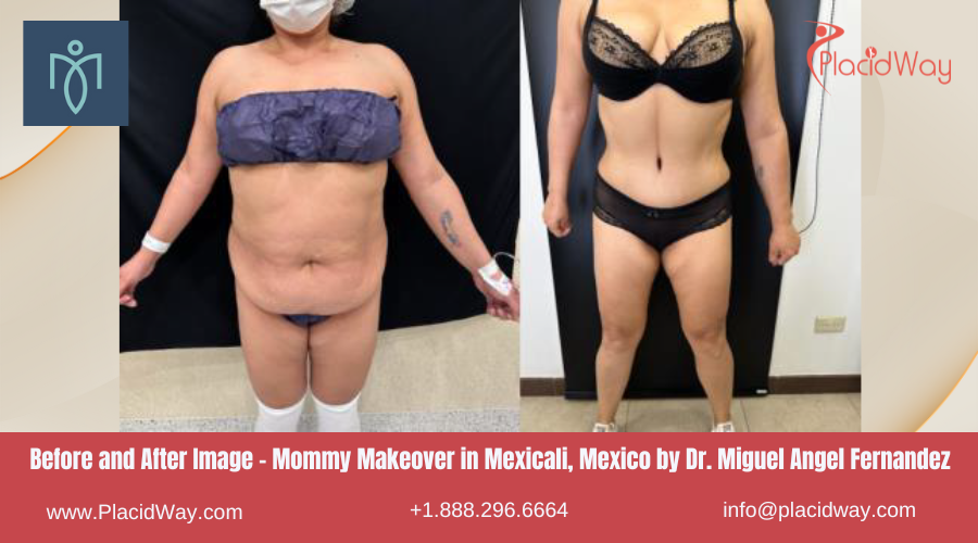 Mommy Makeover in Mexicali Mexico by Dr. Miguel Angel Fernandez