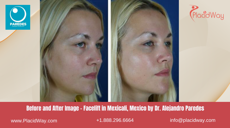 Facelift in Mexicali Mexico by Dr Paredes