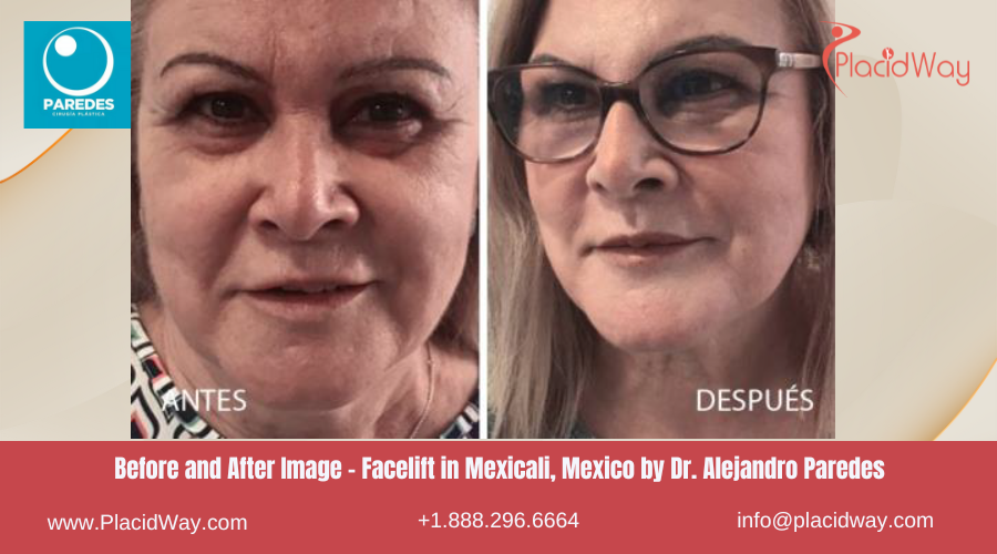 Facelift in Mexicali Mexico by Dr Alejandro Paredes