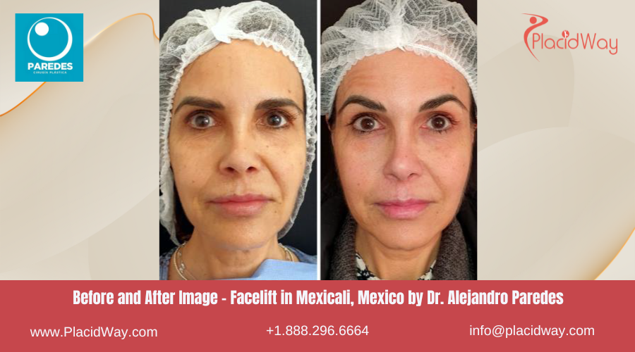 Facelift in Mexicali Mexico at Dr Alejandro Paredes Clinic