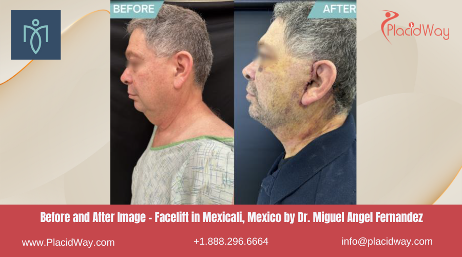 Facelift in Mexicali Mexico by Dr. Miguel Angel Fernandez Clinic