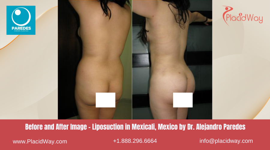 Liposuction in Mexicali Mexico by Dr Paredes