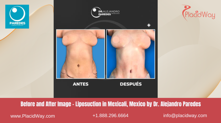 Liposuction in Mexicali Mexico by Dr Paredes Clinic