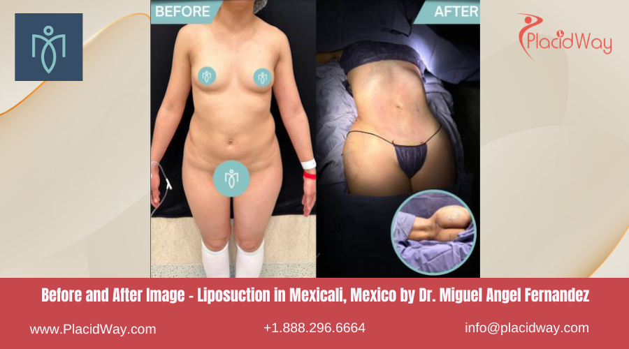 Liposuction in Mexicali Mexico by Dr. Miguel Angel Fernandez