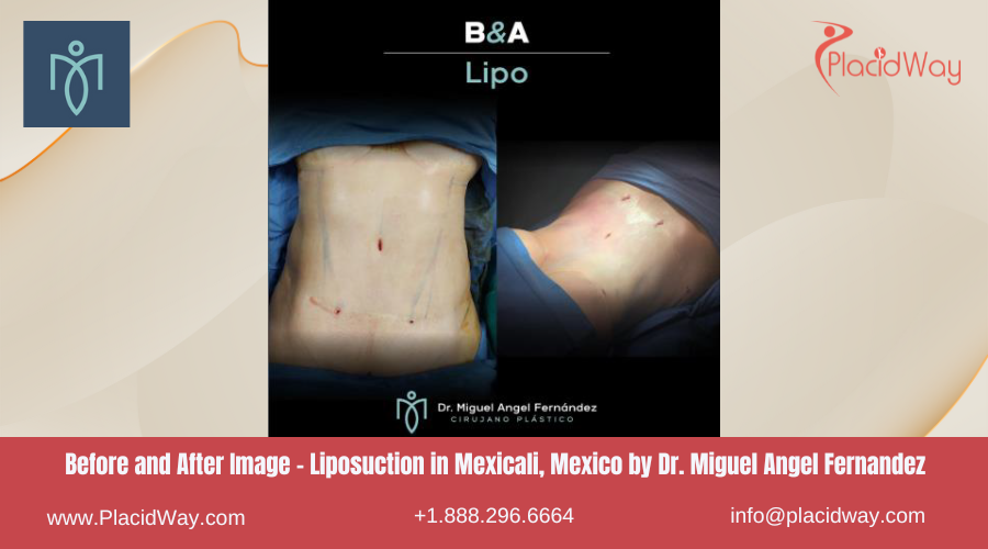 Liposuction in Mexicali Mexico by Miguel Angel Fernandez Clinic