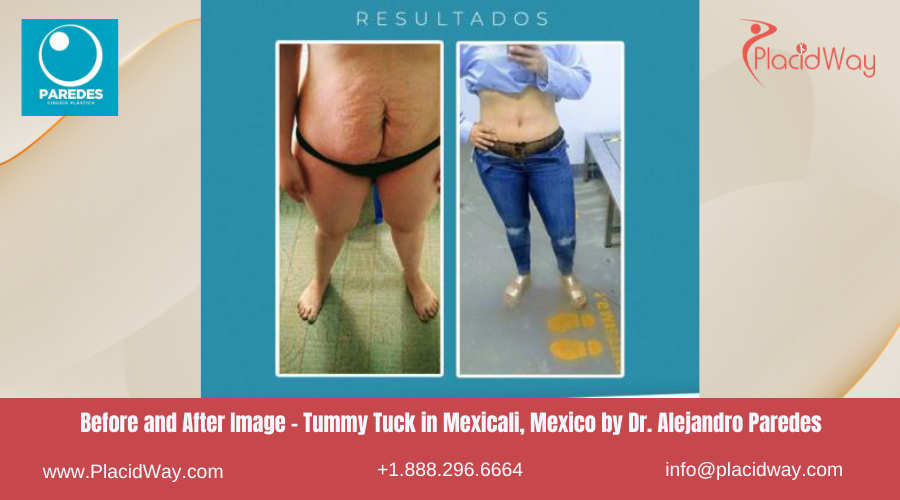 Tummy Tuck in Mexicali Mexico at Dr Paredes