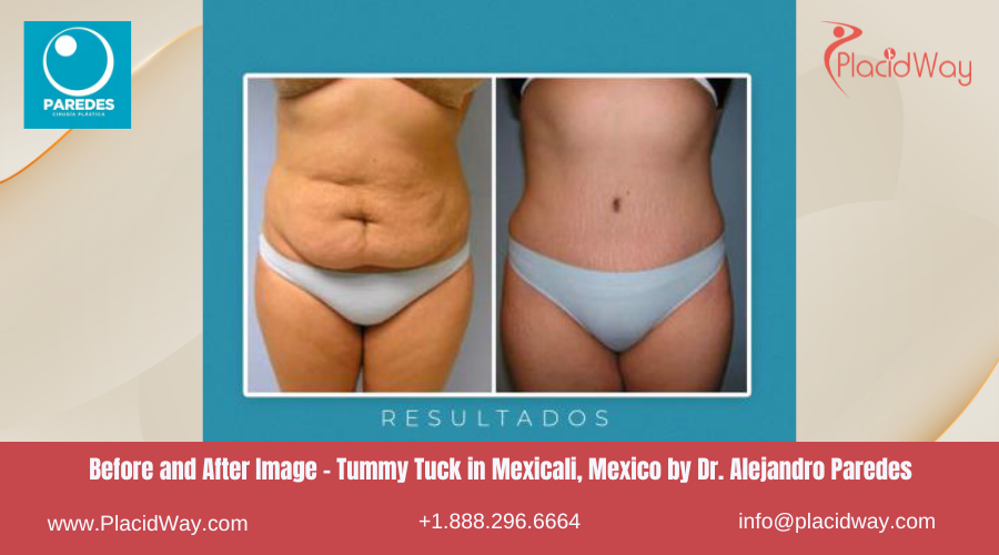 Tummy Tuck in Mexicali Mexico at Dr. Alejandro Paredes