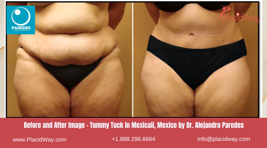 Tummy Tuck in Mexicali Mexico at Dr Paredes Clinic