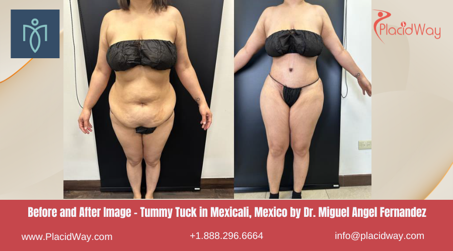 Tummy Tuck in Mexicali Mexico by Dr. Miguel Angel Fernandez Clinic