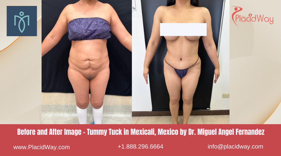 Tummy Tuck in Mexicali Mexico by Dr. Miguel Angel Fernandez Center