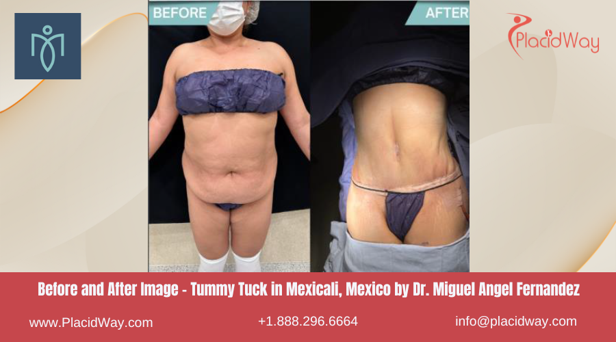 Abdominoplasty in Mexicali Mexico at Dr. Miguel Angel Fernandez