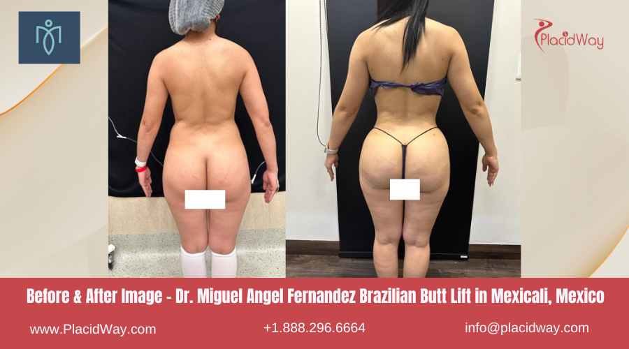 Brazilian Butt Lift in Mexicali Mexico - Miguel Angel Fernandez