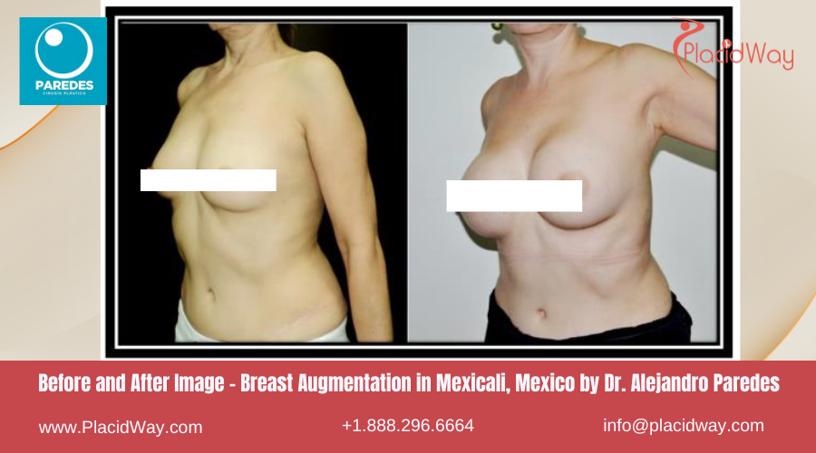 Breast Augmentation in Mexicali Mexico by Dr Paredes